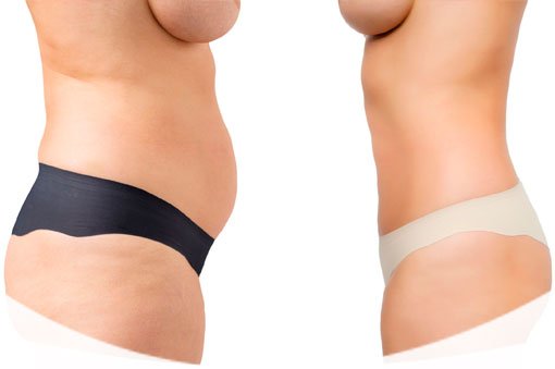 Abdominoplastia en Atocha Abdominoplastia en Atocha