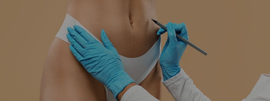 ¿Cómo es un tratamiento de liposucción?